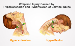 whiplash injury